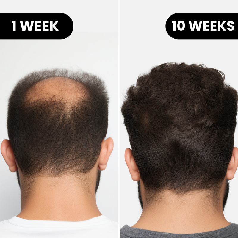 Hair regrowth: 1 week vs 10 weeks before/after